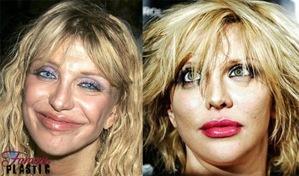 courtney love plastic surgeryphoto