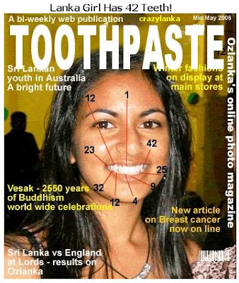 Australian-Sri Lankan girl with 42 teeth