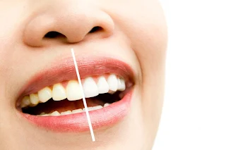 Porcelain Veneers