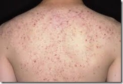 back pimples