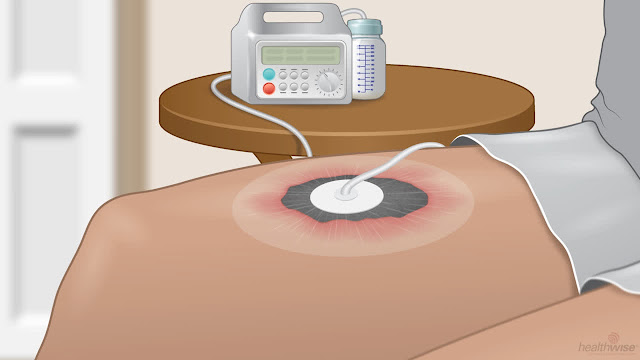 Negative Pressure Wound Therapy (NPWT) Devices Market