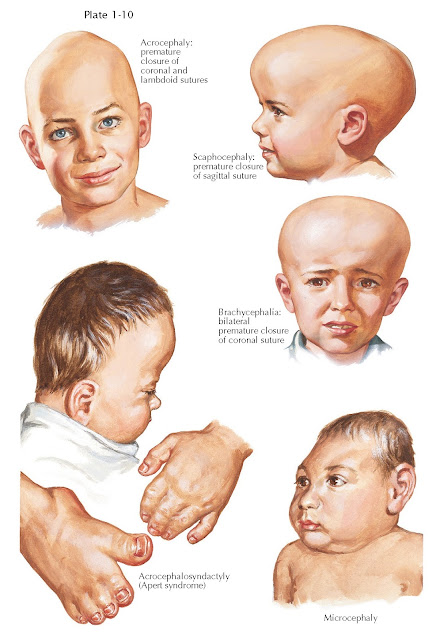 CRANIOSYNOSTOSIS