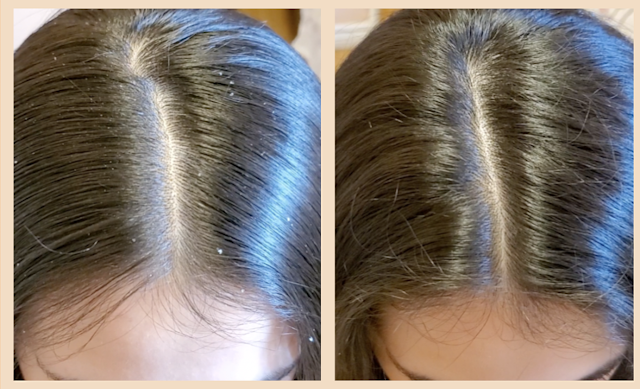dandruff before and after, how to treat clear and remove dandruff, natural home remedy