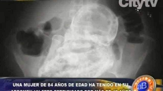 Médicos descobrem feto com mais de 40 anos em corpo de idosa de 82 anos