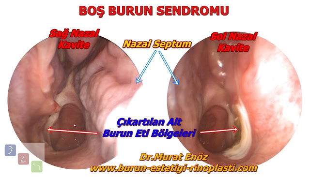 Boş burun sendromu - Boş burun sendromu tedavisi - Empty nose syndrome - Burun eti alınmasının riskleri - Kronik atrofik rinit - Ozena - Sekonder atrofik rinit - Normal nazal havayolu aerodinamiğinin kaybı - Burun etlerinin görevleri