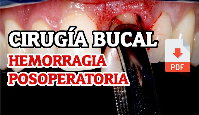 PDF: Hemorragia Posoperatoria en Cirugía Bucal
