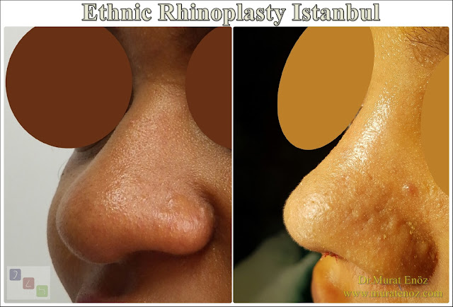 Ethnic Rhinoplasty Istanbul – Nose job in Istanbul – Nose surgery in Istanbul – Nose job in Turkey - Ethnic rhinoplasty Turkey - Ethnic rhinoplasty in Turkey - African American rhinoplasty - Ethnic expert nose job surgeon - Rhinoplasty surgeon in Istanbul - Black nose job - Rhinoplasty for ethnic nose - Rhinoplasty for African people - African American nose surgery – Rhinoplasty for African American Nose - Thick skin rhinoplasty - Rhinoplasty in istanbul