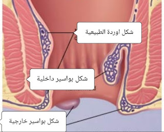 علاج البواسير الداخلية و الخارجية بالمنزل