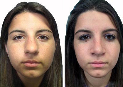 Human Surgeryes: Nose Job Before After picture