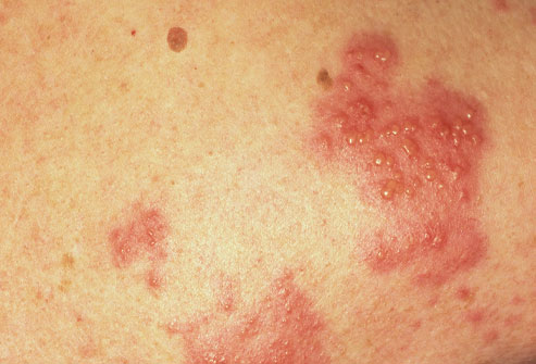 Shingles often occurs on the trunk and buttocks, 