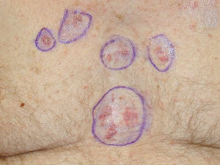 skin cancer photos early stages