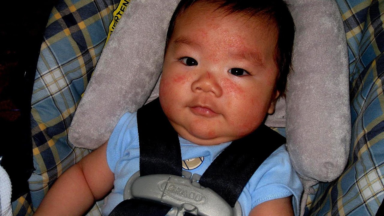 Formulas For Milk Protein Allergy