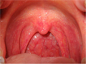 A picture of a sore throat