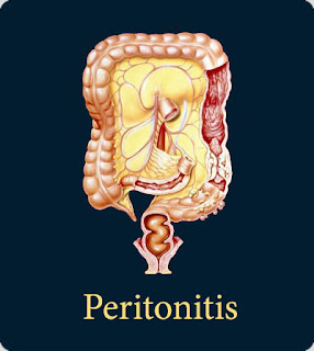 Peritonitis