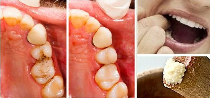 Relieve Dental Caries Pain At Home