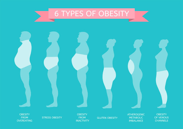 obesity in various stages