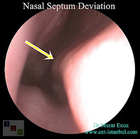 Nasal septum deviation, Deviated nose septum, Nasal congestion, Caudal septum dislocation, Anterior septal dislocation