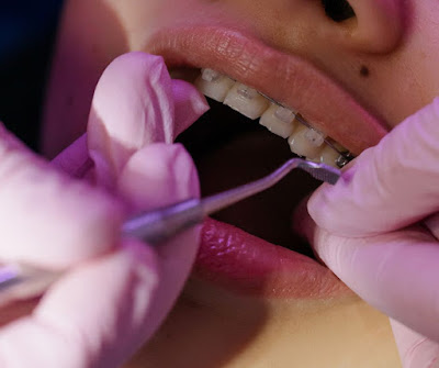 Dental braces Rego Park