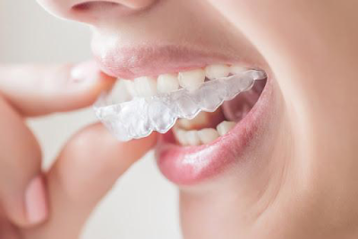 Quy trình niềng răng không đau tại nha khoa