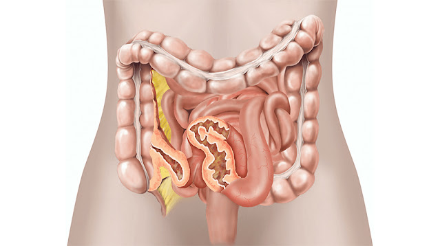 Ulcerative Colitis Market