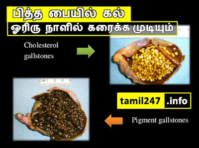 பித்த பை கல் வெளிவர, பித்தப்பை கல் கரைய,  இயற்க்கை முறையில் அகற்ற, Natural treatments in Tamil, Natural Cure in Tamil, gallbladder stone, Naturally remove Gall blader stone tips in tamil. How to remove gall bladder stone