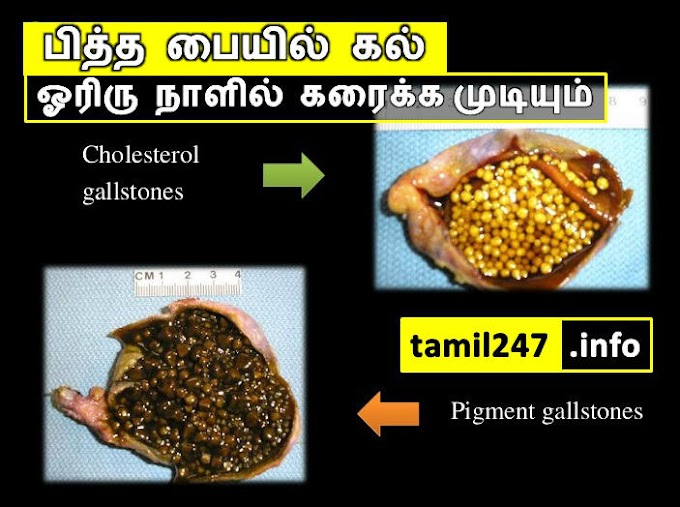 பித்த பையில் கல்லா, அதை ஓரிரு நாளில் கரைக்க முடியும், தெரியுமா?