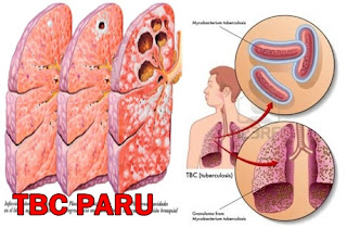 Penyakit TBC Paru Paru