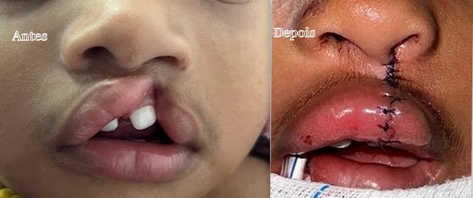 Criança de 2 anos passa por correção de lábio fissurado no Hospital Materno-Infantil, em Ilhéus