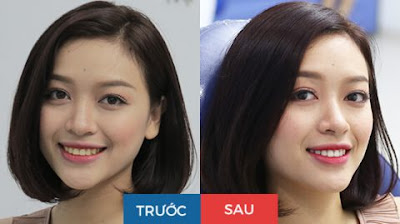 Hình ảnh trước và sau khi tẩy trắng răng whitemax