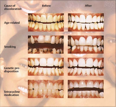 Causes of Tooth Discoloration
