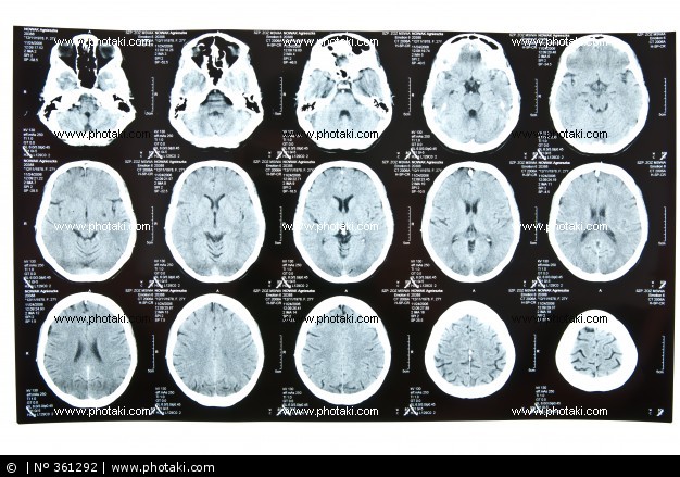 Brain X ray1