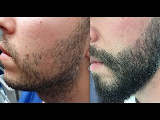 facial hair transplant Islamabad