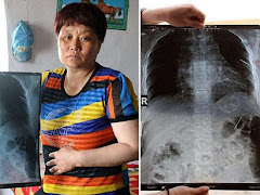 Misteri 10 Tahun Pin Dan Jarum Dalam Badan