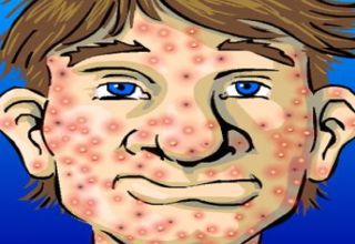 L'acné est une dermatose (maladie de la peau) inflammatoire des follicules pilosébacés (les glandes sécrétant le sébum, à la racine des poils) avec formation de comédons. Typiquement, elle commence à la puberté et touche principalement les adolescents, de façon plus ou moins sévère. Elle cesse spontanément, le plus souvent à la fin de l'adolescence.