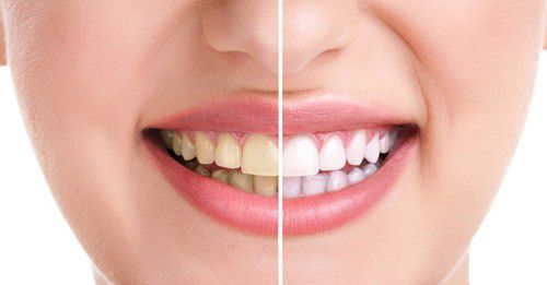 Lấy cao răng có gây ảnh hưởng đến nướu không? - Nha Khoa Kim 1