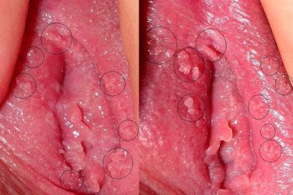 Bagaimana Jika Daging Tumbuh di Vagina Memek Itu Kutil Kalamin