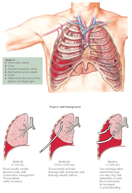 HEMOTHORAX