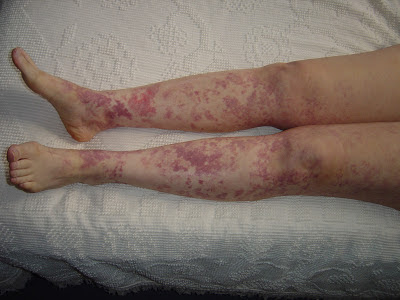 My Legs with rash from vitamins.jpeg