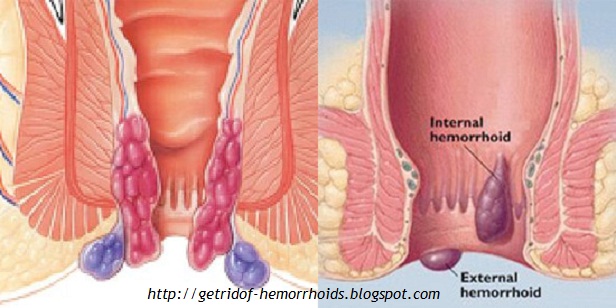 Ciri Gejala Wasir