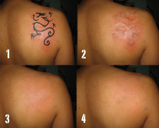 Tattoos Removal