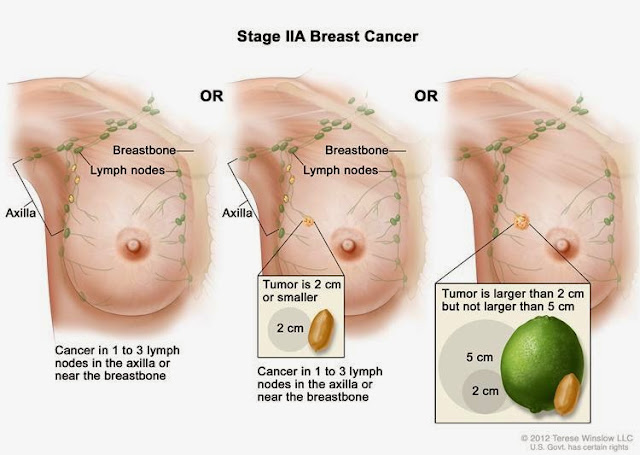 Main causes of breast cancer you should know