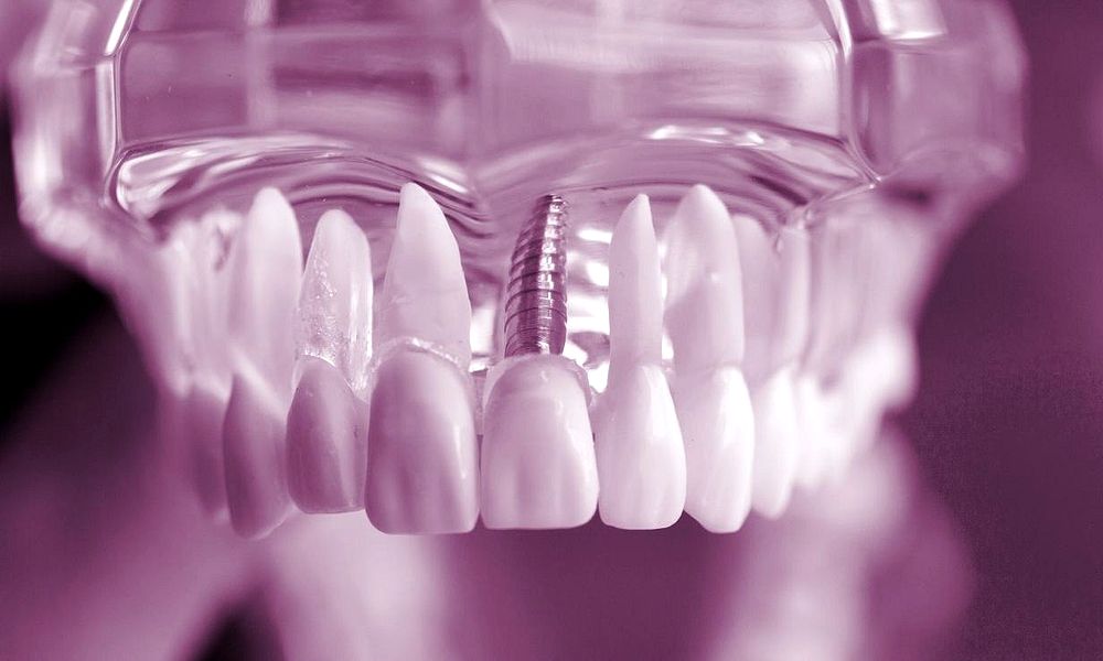 Implantes Dentales