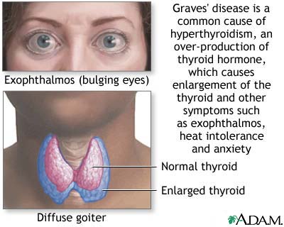 Knowing Graves' Disease