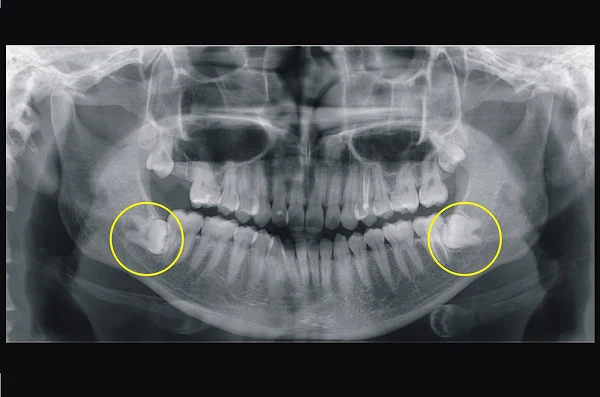 ▲環口影像可見雙側阻生智齒牙根皆緊鄰下齒槽神經。（彰基醫院提供）