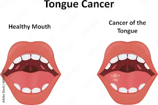 What is Tongue Cancer