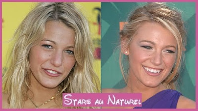 blake lively nose job