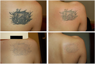 Laser Tattoo Removal Before and After Pictures | Tattoo Removal ...