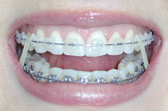 teeth braces before and after. house Before and after