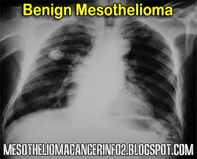 Everything You Wanted to Know About Benign Mesothelioma | TYPES, SYMPTOMS & TREATMENT and Were Afraid To Ask