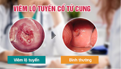 cách phát hiện viêm lộ tuyến cổ tử cung